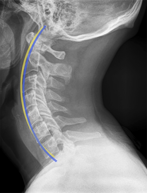 Cervical curve restored — after