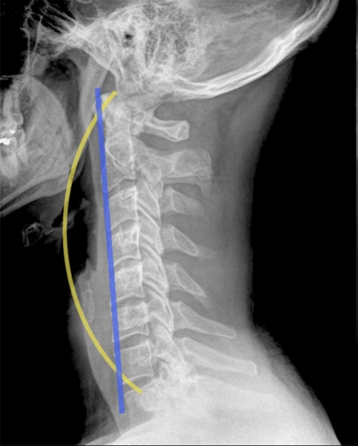 Cervical curve restored — before